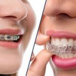Best Orthodontist in Bhopal