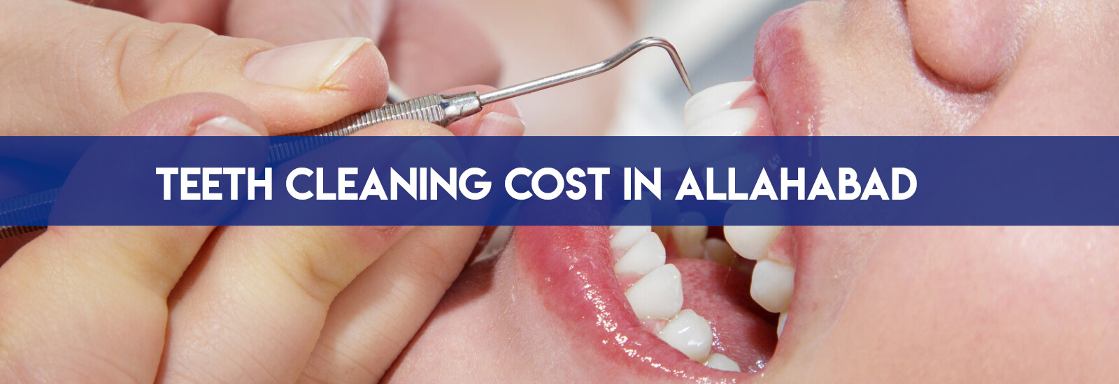 Teeth Cleaning Cost in Allahabad