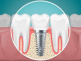 Dental Implants in Guntur